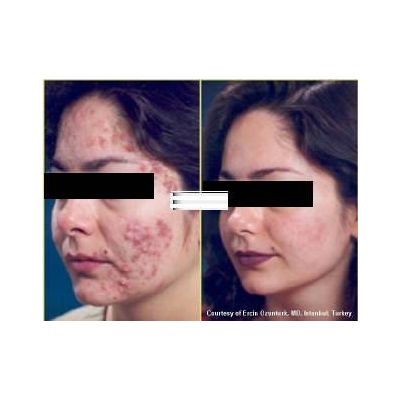 PIGMENTATION CURE INJECTIONS- FAST EFFECTIVE RESULT IN 7 DAYS