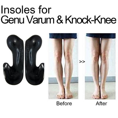 Functional Shoe Insoles for Correction of Genu Varum, Knock-Knee, X-Bein Legs (Made in South Korea)