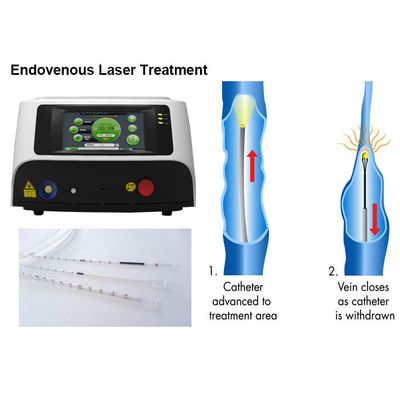 EVLA Endovenous Laser Therapy Varicose Veins Treatments Without Any Pain Medication