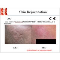 PRP KIT / Aesthetic / Skin rejuvenation / thumbnail image