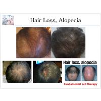 PRP Kit / Aesthetic / Hair Loss / thumbnail image