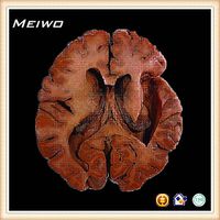 Lateral ventricles anatomical specimens thumbnail image
