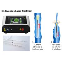 EVLA Endovenous Laser Therapy Varicose Veins Treatments Without Any Pain Medication thumbnail image