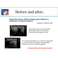 PRP Kit / Orthopedics / Rehab / thumbnail image